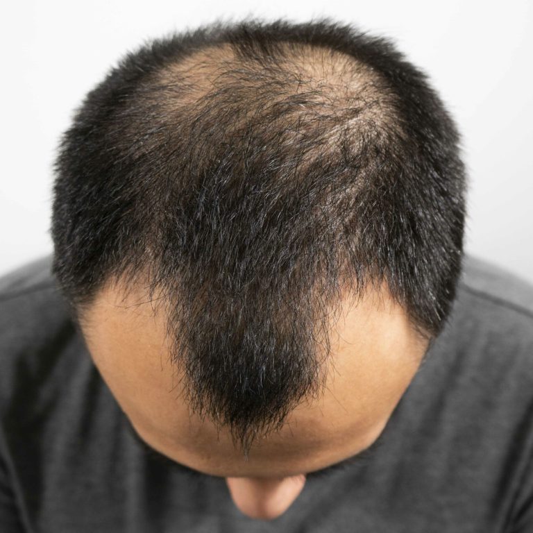 HairScience_Man-with-androgenetic-alopecia-scaled