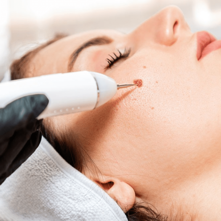 Mole removal treatment at cosderma clinic