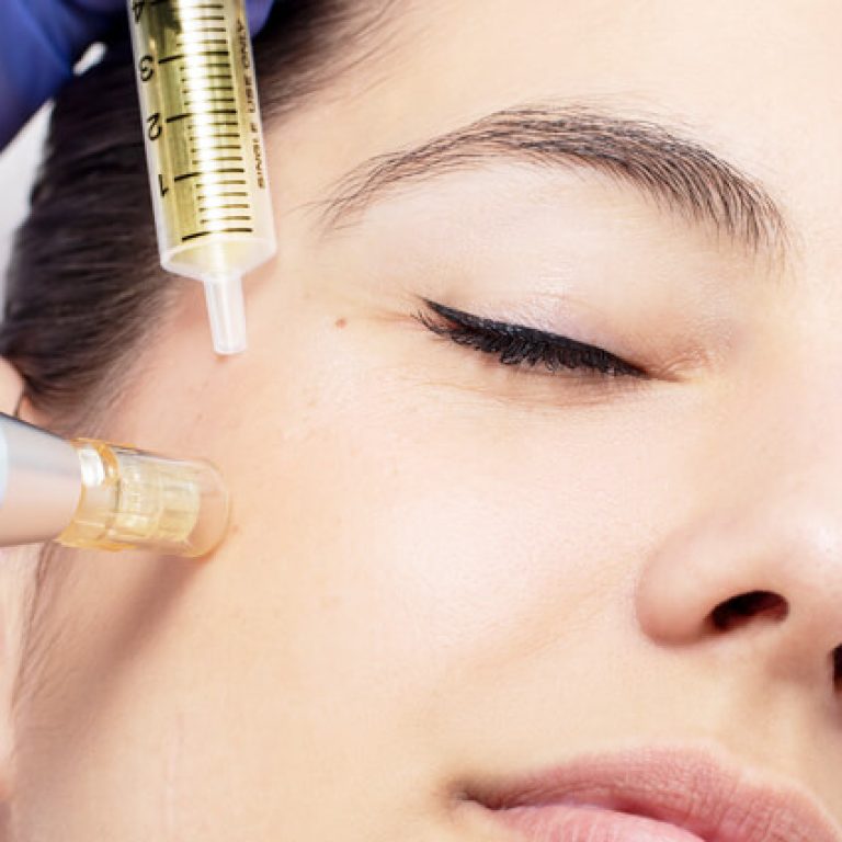 Revive-Face-Mesotherapy