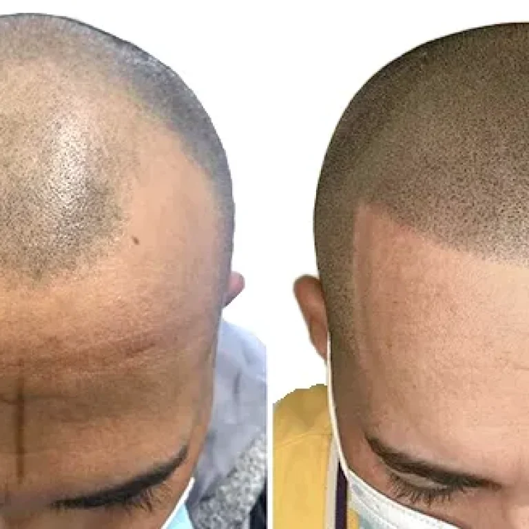 Scalp-Micro-Pigmentation-Can-be-Suitable-Option-For-Individuals-Experiencing