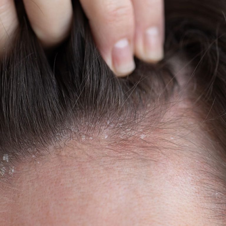 Seborrheic-Dermatitis-symptoms