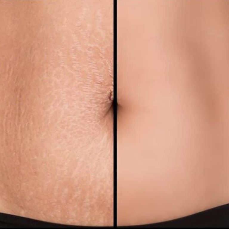 Stretch Marks Treatment
