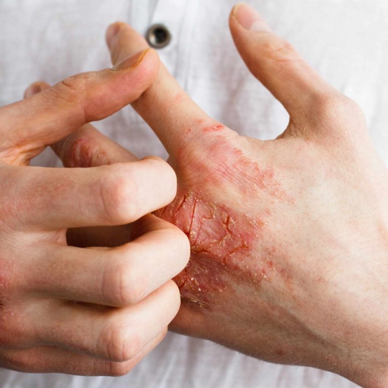 Psoriasis Management Malad Mumbai