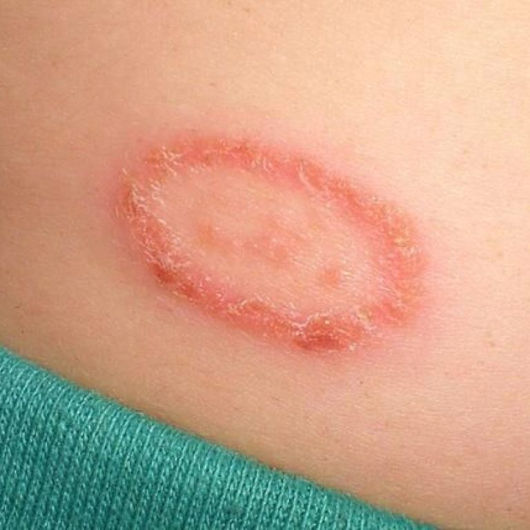 Best Fungal Infection Clinic Malad mumbai