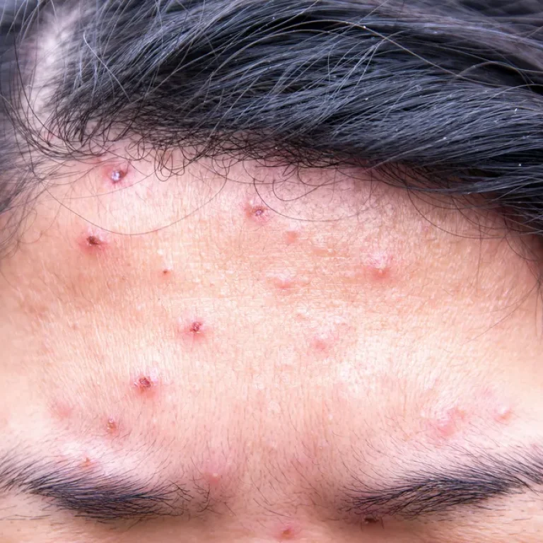 chicken_pox_scar_removal mumbai malad