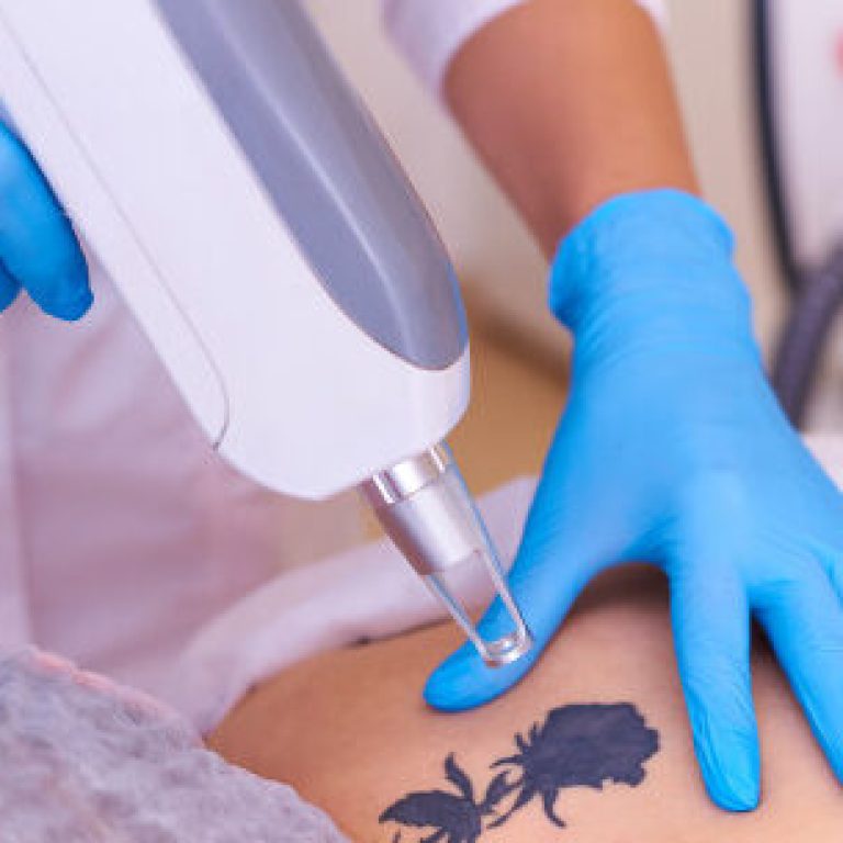 laser-tattoo-removal-cosmetology-clinic_83055-1383