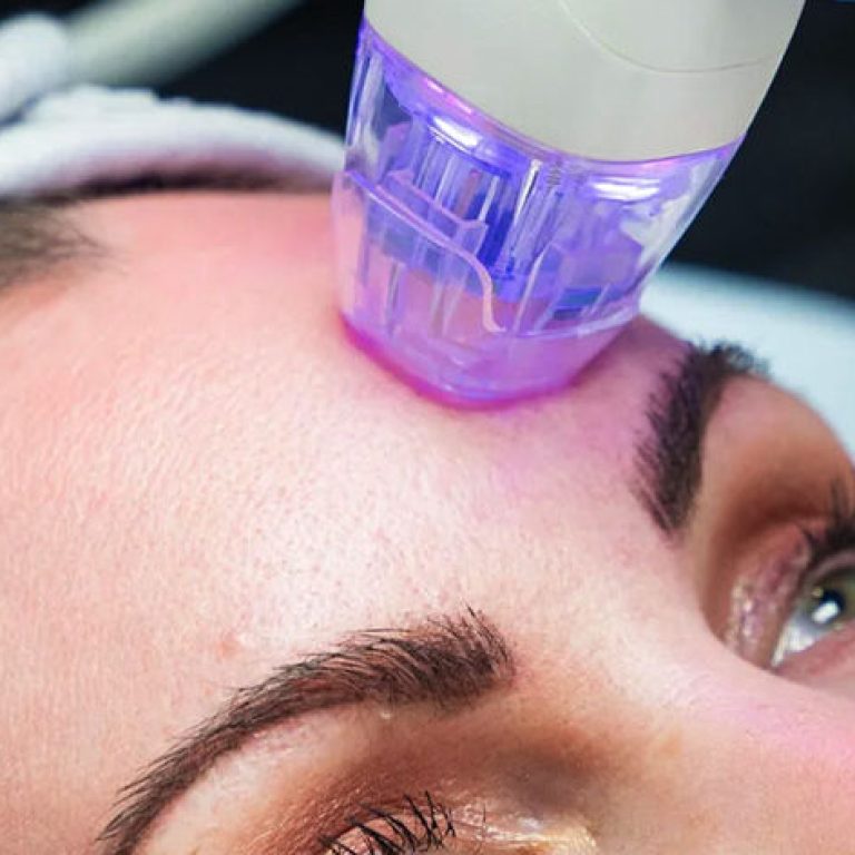 rfmicroneedling