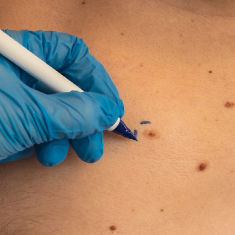 skin-tag-removal-about-c0a4d4710f7db600