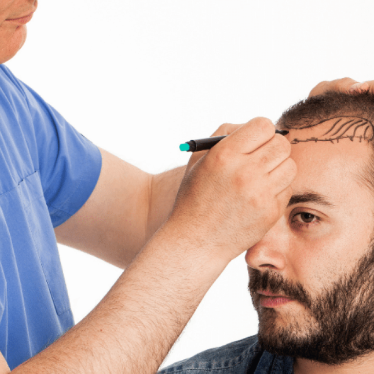 stem-cell-hair-transplant-1200x720