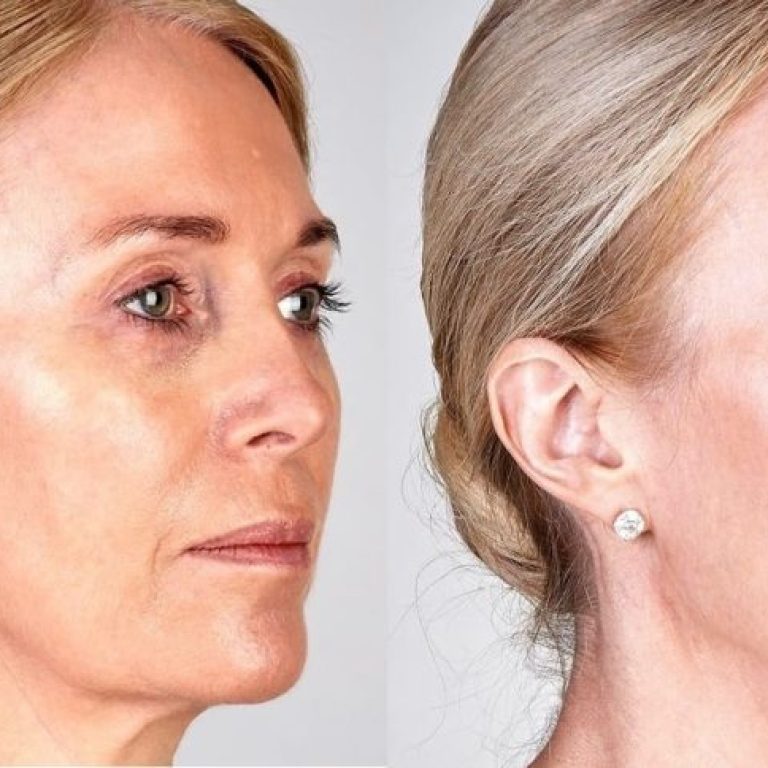 ultherapy-skin-tightening-before-and-after-1024x484
