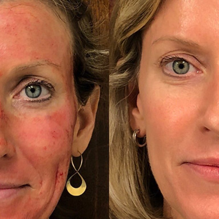 vampire-facial-columbia-skin-clinic